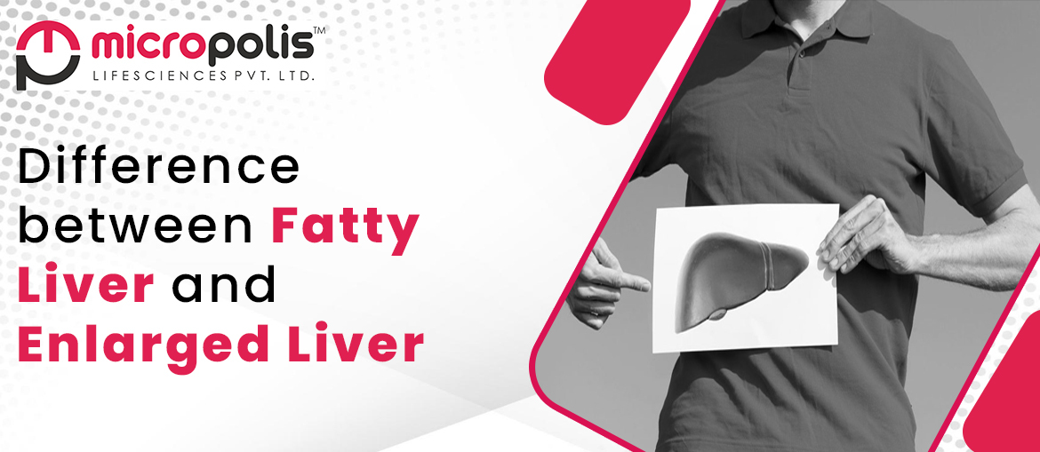 Difference between Fatty Liver and Enlarged Liver